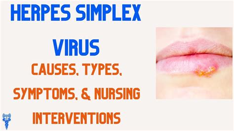 what causes herpes simplex